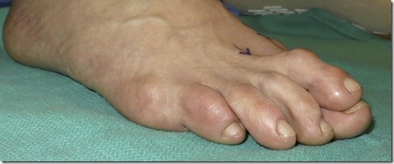 best of Bunions overlapping