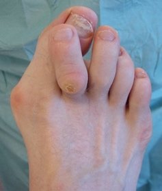 Overlapping bunions